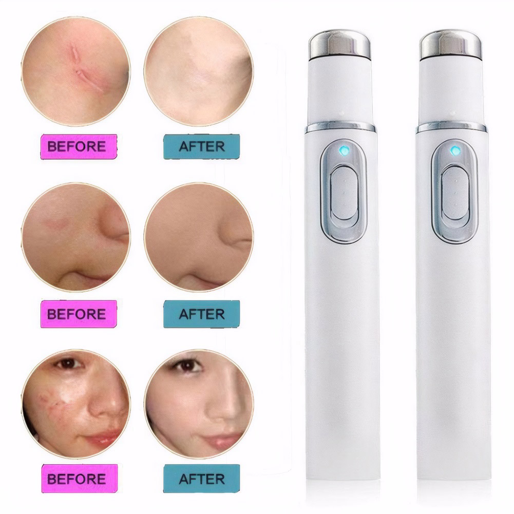 العلاج بالضوء الأزرق قلم حب ال - مراجعة Acne Light Therapy Pen وسعره