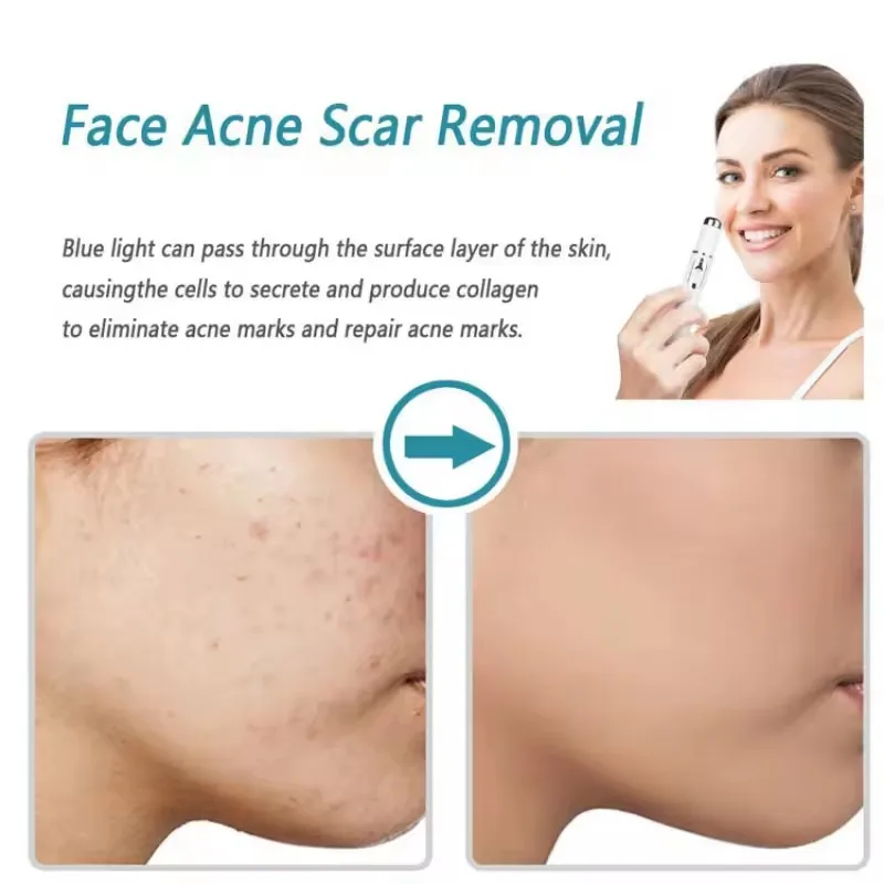 قلم حب الشباب العلاجي بالضوء ا - مراجعة Acne Light Therapy Pen وسعره